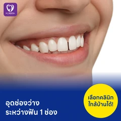 อุดช่องว่างระหว่างฟัน 1 ช่อง
