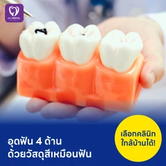 อุดฟัน 4 ด้าน ด้วยวัสดุสีเหมือนฟัน