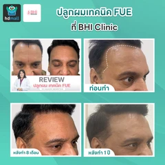 ปลูกผมเทคนิค FUE จำนวนกราฟต์ขึ้นอยู่กับแพทย์ประเมิน