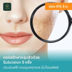 คอร์สรักษาหลุมสิวด้วย Subcision 5 ครั้ง