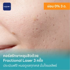 คอร์สรักษาหลุมสิวด้วย Fractional Laser 3 ครั้ง