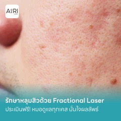 รักษาหลุมสิวด้วย Fractional Laser