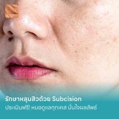 รักษาหลุมสิวด้วย Subcision