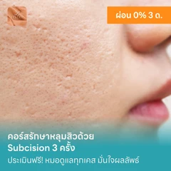 คอร์สรักษาหลุมสิวด้วย Subcision 3 ครั้ง
