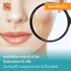 คอร์สรักษาหลุมสิวด้วย Subcision 5 ครั้ง
