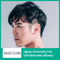 ปลูกผม ด้วยเทคนิค FUE ไม่จำกัดกราฟต์ (ครั้งแรก)