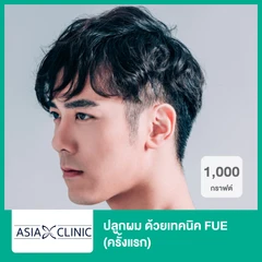 ปลูกผม ด้วยเทคนิค FUE 1,000 กราฟต์ (ครั้งแรก)
