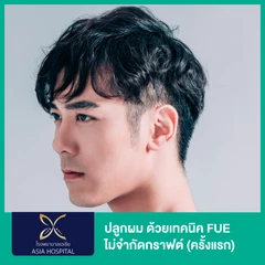 ปลูกผม ด้วยเทคนิค FUE ไม่จำกัดกราฟต์ (ครั้งแรก)