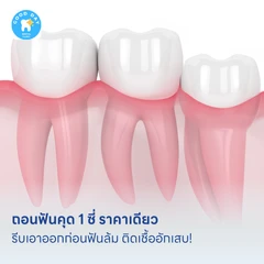 ถอนฟันคุด 1 ซี่ ราคาเดียว