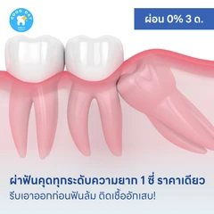 ผ่าฟันคุดทุกระดับความยาก 1 ซี่ ราคาเดียว