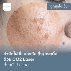 กำจัดไฝ ขี้แมลงวัน ติ่งเนื้อ กระเนื้อ ด้วย CO2 Laser ขนาดเส้นผ่านศูนย์กลางไม่เกิน 2 มม. ไม่จำกัดจุดทั่วใบหน้าหรือลำคอ