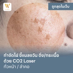กำจัดไฝ ขี้แมลงวัน ติ่งเนื้อ กระเนื้อ ด้วย CO2 Laser ขนาดเส้นผ่านศูนย์กลางไม่เกิน 2 มม. ไม่จำกัดจุดทั่วใบหน้าหรือลำคอ 1 ครั้ง