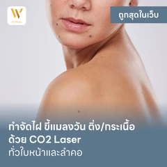 กำจัดไฝ ขี้แมลงวัน ติ่งเนื้อ กระเนื้อ ด้วย CO2 Laser ขนาดเส้นผ่านศูนย์กลางไม่เกิน 2 มม. ไม่จำกัดจุดทั่วใบหน้าและลำคอ 1 ครั้ง