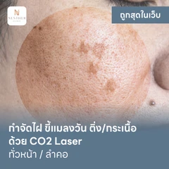 กำจัดไฝ ขี้แมลงวัน ติ่งเนื้อ กระเนื้อ ด้วย CO2 Laser ขนาดเส้นผ่านศูนย์กลางไม่เกิน 2 มม. ไม่จำกัดจุดทั่วใบหน้าหรือลำคอ 1 ครั้ง