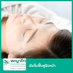 ฝังเข็มฟื้นฟูผิวหน้า