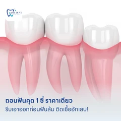 ถอนฟันคุด 1 ซี่ ราคาเดียว