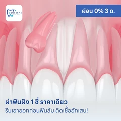 ผ่าฟันฝัง 1 ซี่ ราคาเดียว