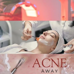 รักษาสิวหน้า 4 ขั้นตอน (Acne Away)