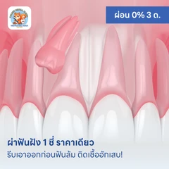 ผ่าฟันฝัง 1 ซี่ ราคาเดียว