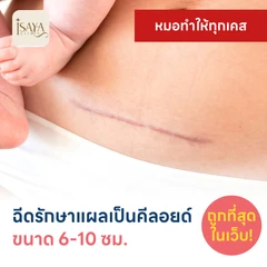 ฉีดรักษาแผลเป็นคีลอยด์ ขนาดเส้นผ่านศูนย์กลาง 6-10 ซม. 1 จุด 1 ครั้ง
