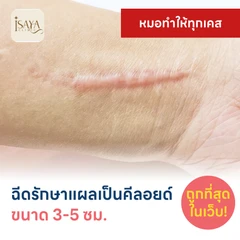 ฉีดรักษาแผลเป็นคีลอยด์ ขนาดเส้นผ่านศูนย์กลาง 3-5 ซม. 1 จุด 1 ครั้ง