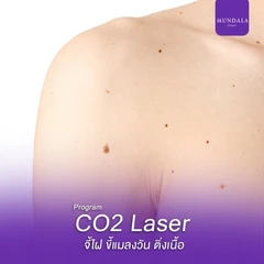 จี้ไฝ ขี้แมลงวัน ติ่งเนื้อ ด้วยเลเซอร์ CO2 ขนาดไม่เกิน 1.1 มม.