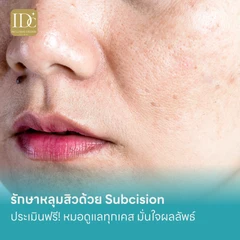 รักษาหลุมสิวด้วย Subcision