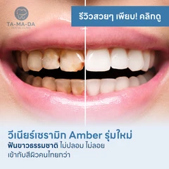 HDmall แนะนำ : ทำวีเนียร์เซรามิก รุ่นใหม่ ฟันขาวสวยธรรมชาติ ไม่ปลอม ไม่ลอย ที่ Ta-ma-da Clinic (MRT สามย่าน)