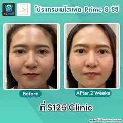 โปรแกรมเมโสแฟตหน้า Prime 8 ซีซี