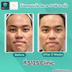 คอร์สโปรแกรมเมโสหน้า Acne 5 ซีซี 5 ครั้ง