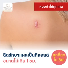 ฉีดรักษาแผลเป็นคีลอยด์ ขนาดเส้นผ่านศูนย์กลางไม่เกิน 1 ซม. 1 จุด 1 ครั้ง
