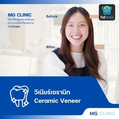 ทำวีเนียร์เซรามิกหรือพอร์ซเลน E-Max 1 ซี่
