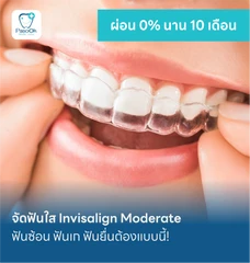จัดฟันใส Invisalign Moderate