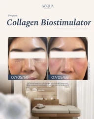 โปรแกรม Collagen Biostimulators 10 ซีซี (หน้า)