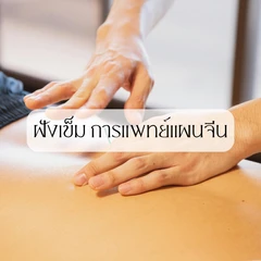 ฝังเข็ม คลายจุดกล้ามเนื้อตามร่างกาย