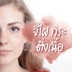 จี้ไฝ กระ ติ่งเนื้อ ด้วยจี้ไฟฟ้า ขนาดไม่เกิน 0.5 ซม. 1 จุด