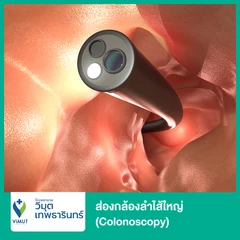 ส่องกล้องลำไส้ใหญ่ (Colonoscopy) ด้วยวิธีให้ยานอนหลับ โดยวิสัญญีแพทย์