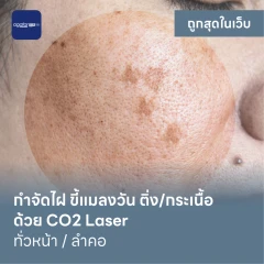 กำจัดไฝ ขี้แมลงวัน ติ่งเนื้อ กระเนื้อ ด้วย CO2 Laser ขนาดเส้นผ่านศูนย์กลางไม่เกิน 2 มม. ไม่จำกัดจุดทั่วใบหน้าหรือลำคอ 1 ครั้ง