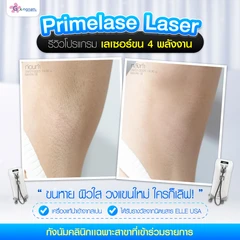 คอร์สเลเซอร์กำจัดขนรักแร้ 4 พลังงาน เครื่องแท้ Primelase จากสเปน 12 ครั้ง ภายใน 1 ปี (1 สิทธิ์/ท่าน)