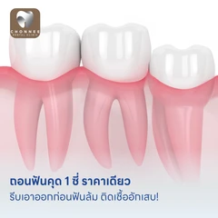 ถอนฟันคุด 1 ซี่ ราคาเดียว