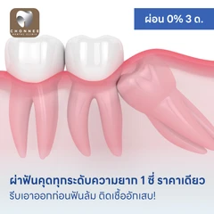 ผ่าฟันคุดทุกระดับความยาก 1 ซี่ ราคาเดียว