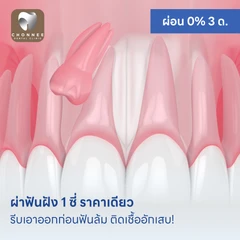 ผ่าฟันฝัง 1 ซี่ ราคาเดียว