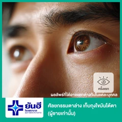 ศัลยกรรมตาล่าง เก็บถุงไขมันใต้ตา (ผู้ชายเคสทำครั้งแรกเท่านั้น)