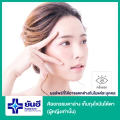 ศัลยกรรมตาล่าง เก็บถุงไขมันใต้ตา (ผู้หญิงเคสทำครั้งแรกเท่านั้น)