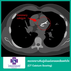 ตรวจคราบหินปูนในผนังหลอดเลือดหัวใจ (CT Calcium Scoring) (สำหรับทุกช่วงวัย)