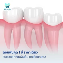 ถอนฟันคุด 1 ซี่ ราคาเดียว