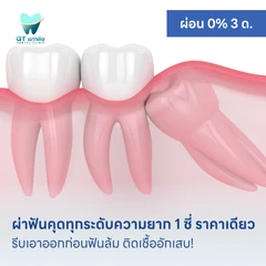 ผ่าฟันคุดทุกระดับความยาก 1 ซี่ ราคาเดียว