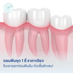 ถอนฟันคุด 1 ซี่ ราคาเดียว