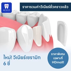 ทำวีเนียร์เซรามิก E-Max Press 6 ซี่