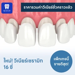 ทำวีเนียร์เซรามิก E-Max Press 16 ซี่